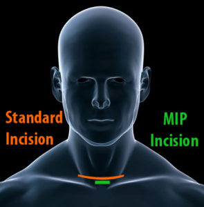 Parathyroidectomy Incision