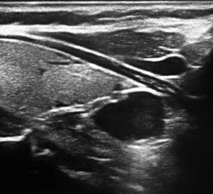 Ultrasound image possibly showing a section of human anatomy for diagnostic purposes.