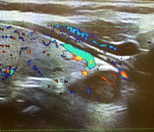 Doppler ultrasound image showing blood flow in a human body part.