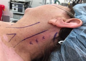 Preoperative marking on a patient's neck for thyroid or parathyroid surgery.