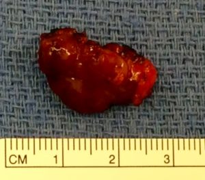 Parathyroid adenoma specimen alongside a centimeter ruler for scale.