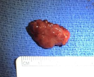 Parathyroid adenoma specimen next to a ruler for scale.