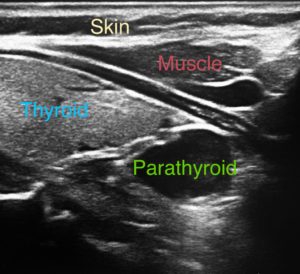 Ultrasound image of neck showing thyroid and parathyroid glands with labeled anatomical structures.