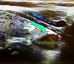 Doppler ultrasound image of a parathyroid gland with blood flow indicated.