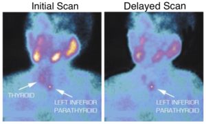 Initial and delayed scan images of a parathyroid Sestamibi scan showing thyroid and left inferior parathyroid.