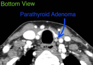 CT scan of a neck showing a bottom view with an arrow indicating a parathyroid adenoma.
