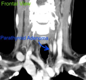 CT scan of the neck in frontal view showing a parathyroid adenoma.