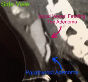 CT scan image showing a side view of a parathyroid adenoma with an arrow indicating the blood vessel feeding it.