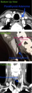 CT scan images from different angles showing a parathyroid adenoma with labeled features.