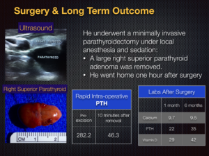 right superior parathyroid surgery and long term outcome