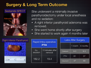 right inferior parathyroid surgery and long term outcome