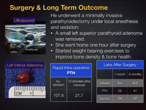 left interior parathyroid adenoma surgery and long term outcome