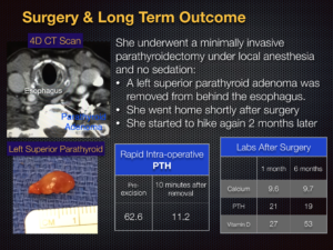 left superior parathyroid surgery and long term outcome