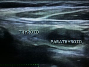 Ultrasound image showing the thyroid and parathyroid regions labeled.