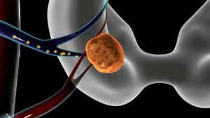 parathyroid adenoma depiction