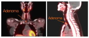 Two medical scan images showing adenomas, one from a frontal view and the other from a side view.