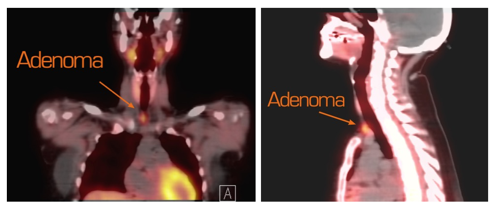 SPECT & CT Fusion Scan