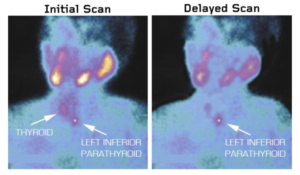 Side-by-side comparison of initial and delayed scans highlighting the thyroid and left inferior parathyroid.