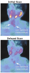 Sestamibi scans for left inferior parathyroid adenoma