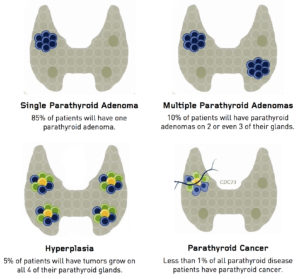 Types of parathyroid adenomas