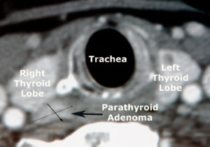 CT scan of the neck with labeled trachea, right and left thyroid lobes, and an arrow indicating a parathyroid adenoma.