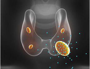 Parathyroid Adenoma