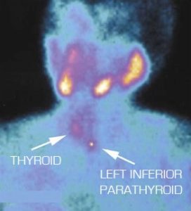 Medical scan image highlighting the thyroid and left inferior parathyroid glands.