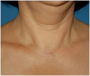 womans neck with invisible parathyroid surgery scar