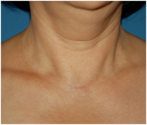 Human neck showing healed surgical scar on the lower front area.