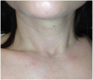 Parathyroid scar 7