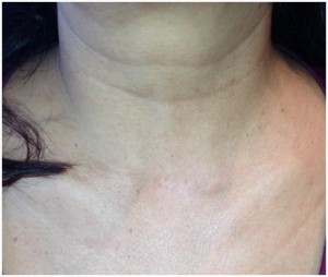 female patients neck with a parathyroid surgery scar