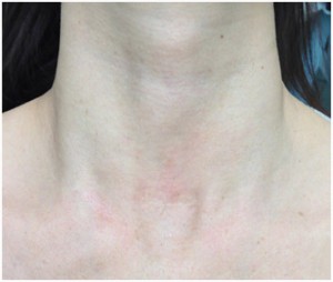 Neck showing faint surgical scar across the lower throat area.
