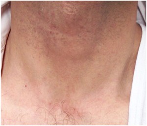 Human neck showing post-operative scarring and healing.
