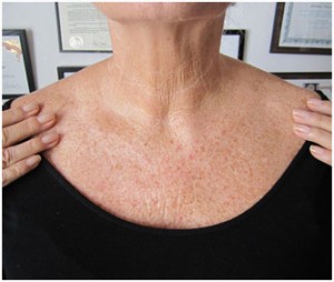 Person with visible neck and chest freckling wearing a black top and hands on shoulders.