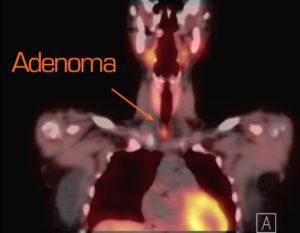 PET scan image with an arrow pointing to a parathyroid adenoma.