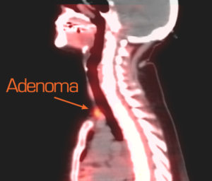 Medical scan highlighting an adenoma in the neck region.