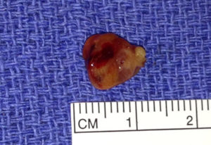 Right Superior Adenoma