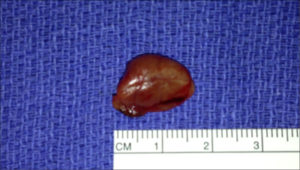 Right Inferior Adenoma