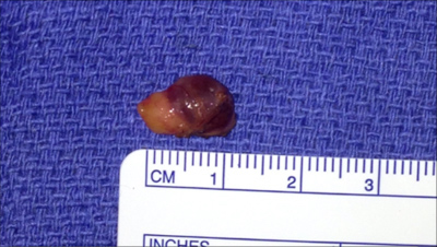 parathyroid tumor 1cm