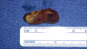 Left Inferior Adenoma 3cm