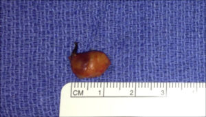 Parathyroid adenoma specimen next to a ruler for scale.