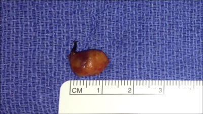 parathyroid tumor 1.2 cm