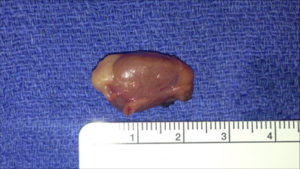 Right Inferior Adenoma measured at 2.5cm