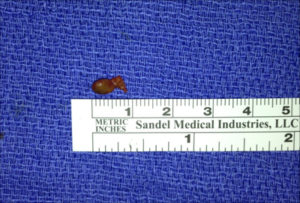 Left Inferior Adenoma measured at one inch