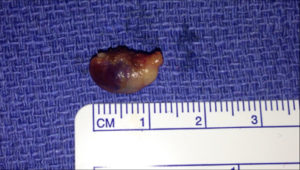 Right Inferior Adenoma measured at 1.5cm