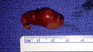 Removed parathyroid gland next to a ruler for scale