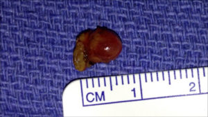 Removed parathyroid gland next to a ruler for scale.