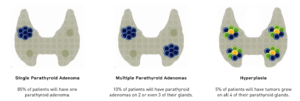 Illustrations showing different conditions of the parathyroid glands: single adenoma, multiple adenomas, and hyperplasia.