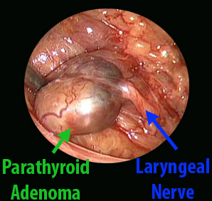 Endoscopic image of a parathyroid adenoma near the laryngeal nerve with labels.