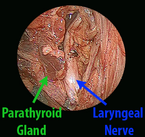 Endoscopic view of a parathyroid gland and laryngeal nerve with labels.